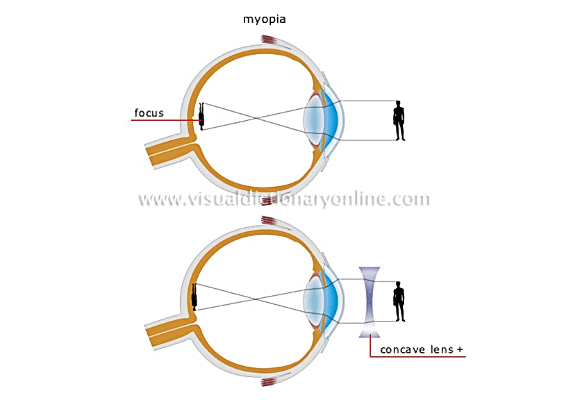 vision defects [1]